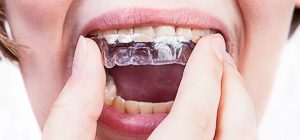 Invisalign Schmerzen: Ursache und Tipps gegen das Druckgefühl im Mund