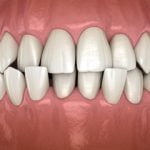 18093Feste Zahnspange: Welche Zahnspange-Brackets die richtigen sind