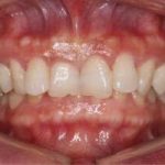 18056Feste Zahnspange: Welche Zahnspange-Brackets die richtigen sind