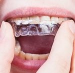 18009Lingualtechnik: Wie die Lingualspange als Zahnspange innen arbeitet