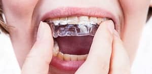 Zahnspangen Zahnbürste: Gibt es spezielle Modelle für die Zahnpflege?