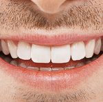 17927Mundfäule (Stomatitis Aphtosa): Herpes auf Zunge, Gaumen und Lippen