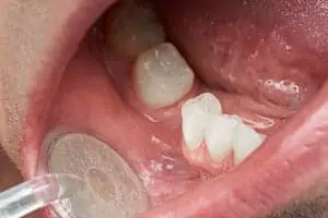 Zahnarzt untersucht Patienten mit fehlendem Backenzahn.