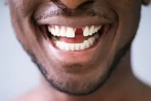 Junger Mann lacht mit fehlendem Zahn