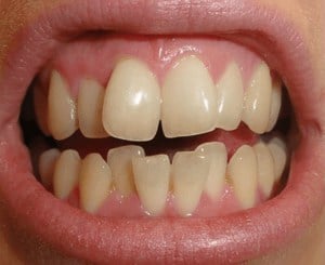 Dr Smile vorher/nachher - schiefe Zähne