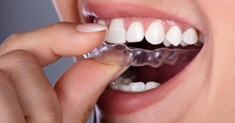 invisalign ratenzahlung