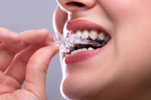 invisalign schmerzen