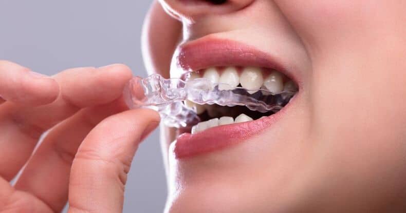 invisalign