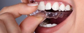 invisalign lite