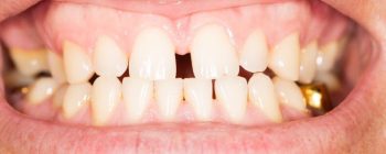 diastema zahnlücke schließen mit zahnspange