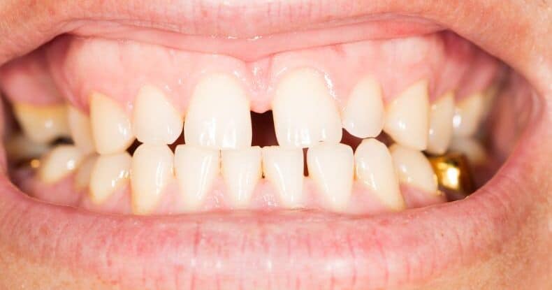 Wie Bekommt Man Eine Zahnlücke Weg Ohne Zahnspange www.dentaly.org