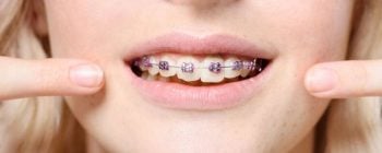 wie schnell verschieben sich zähne mit einer zahnspange