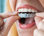 26995Lingualtechnik: Wie die Lingualspange als Zahnspange innen arbeitet