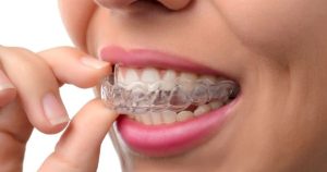 invisalign vorher nacher überbiss