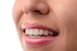 wann braucht man eine zahnspange
