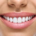 31136Dr Smile vorher/nachher: Mit Alignern zu geraden Zähnen