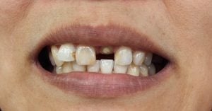 Zahnbehandlung in Mexiko