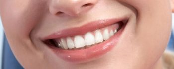 veneers