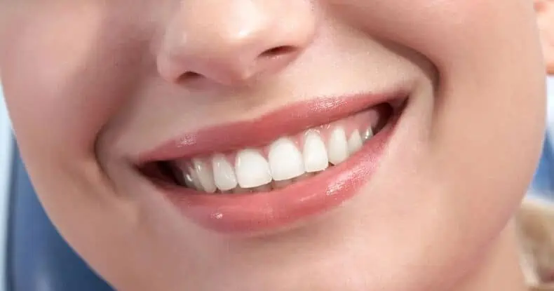 veneers