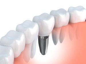 eine gute Alternative zur Einzelzahnprothese ist ein Zahnimplantat