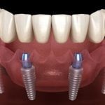 35407Barmenia Zahnzusatzversicherung – Leistung sofort und ohne Wartezeit?