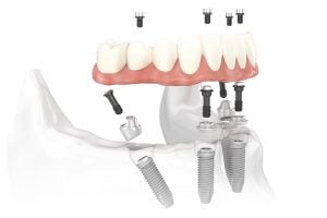Alternative zur Zahnprothese