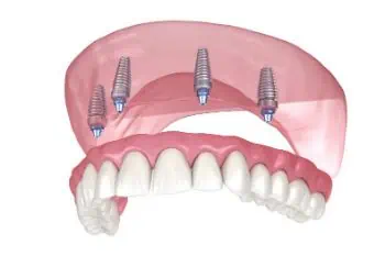 Alternative zur Zahnprothese