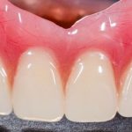 35916Gerade Zähne mit Alignern: Wie läuft die Invisalign Behandlung ab?