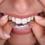 35149Zahnfraktur: Risse im Zahn oder einen Zahnbruch besser reparieren