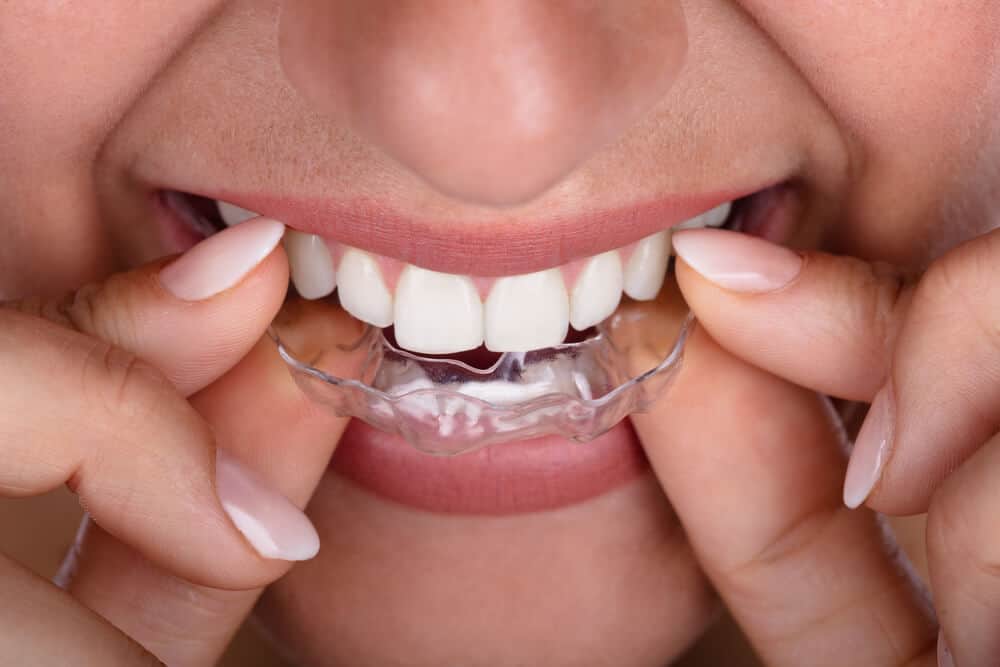 Impress aligners