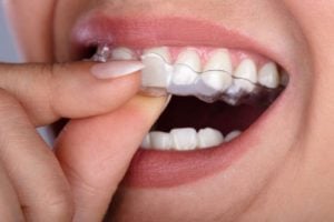 Durchsichtige Zahnschienen im Test