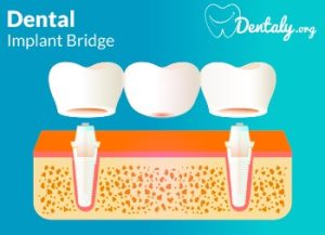 zahnbruecke vs all on 4 implantate