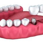 35684Eine Zahnkrone dient dem Aufbau vom Zahn und kann einiges kosten
