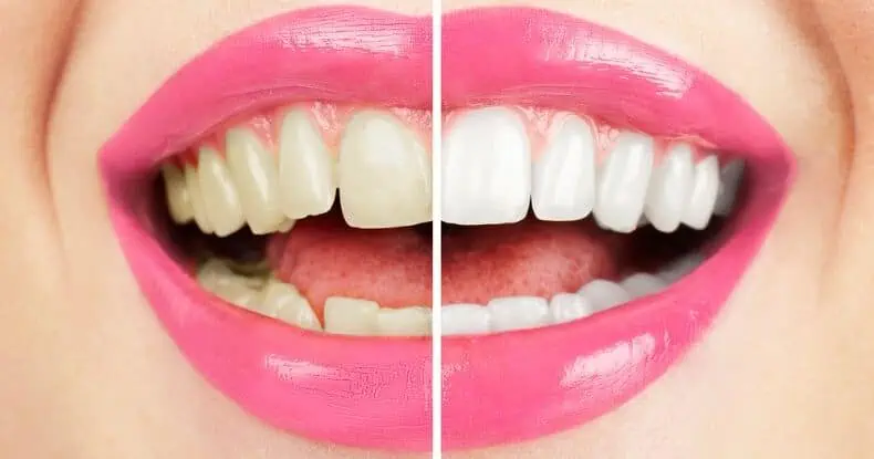 zahnbleaching vorher nachher