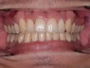 Gerade Zähne der Behandlung mit Invisalign Schienen