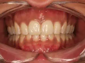 Schöne Zähne nach der Invisalign Schienen Therapie