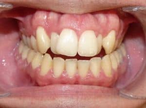 Zahnfehlstellung vor der Behandlung mit Invisalign Schienen