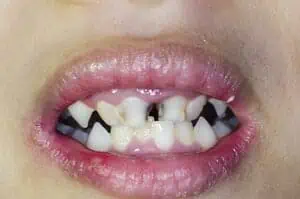 Kind mit verfaulten Zähnen