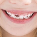 55166Greift die Zahnzusatzversicherung, wenn schon Zähne fehlen?