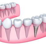 52980Eine Zahnkrone dient dem Aufbau vom Zahn und kann einiges kosten