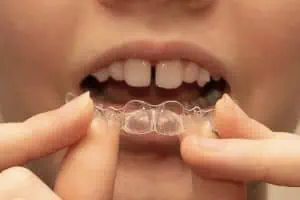 Invisalign Teen