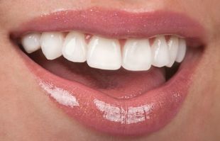 Komposit Veneers