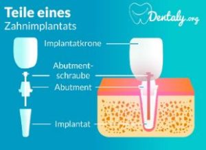 Aufbau eines Zahnimplantats vs Brücke