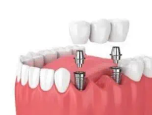 Zahnbrücke auf Implantaten