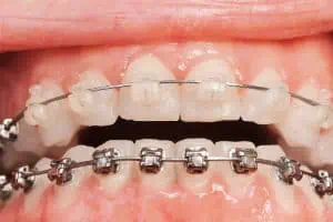 Durchsichtige Brackets obere Zahnreihe