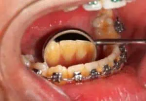 gelbe Zähne durch Zahnspange