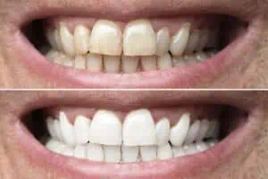 Gelbe Zähne vorher nachher Bleaching