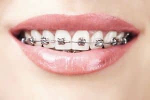 metall-brackets