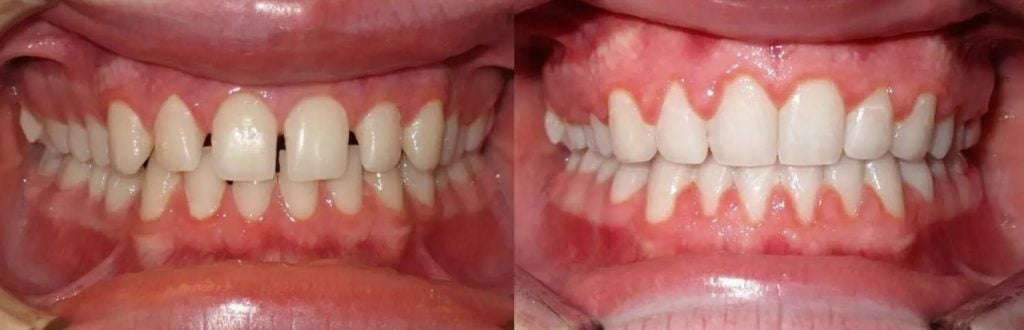 Zahnspange Diastema Vorher-Nachher-Fotos