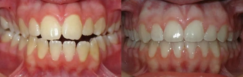Zahnspange offener biss Vorher-Nachher-Fotos